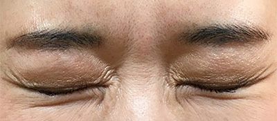 ボトックス 症例1 After