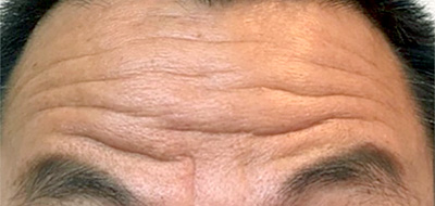 ボトックス 症例2 Before