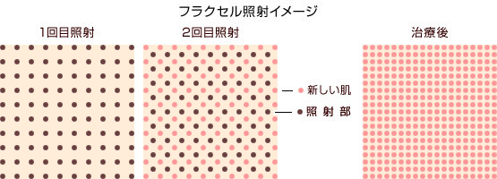 フラクショナルCo2レーザー