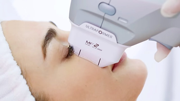 高密度焦点式超音波(HIFU:ハイフ)の医療機器「ウルトラフォーマーIII」