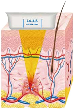HIFU照射後の組織の修復と再構築メカニズム (1)HIFUを照射