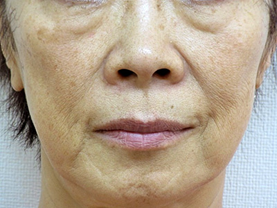 ヒアルロン酸 症例1 施術前
