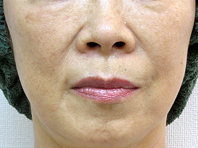 ヒアルロン酸 症例1 施術2週間後