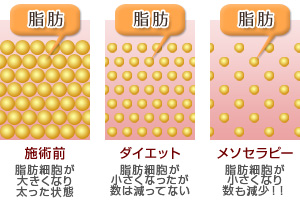 メソセラピー(脂肪溶解注射)は脂肪細胞の数自体が減っていきます。