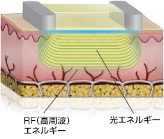 トリニティプラス（RF+IR）