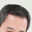 薄毛ができやすい部分 頭