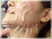 リードファインリフト